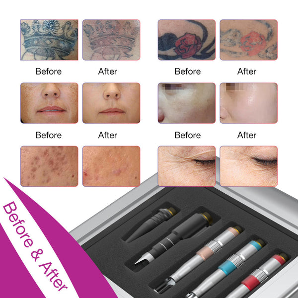 Your Comprehensive Guide to Finding the Ultimate Tattoo Removal Solution